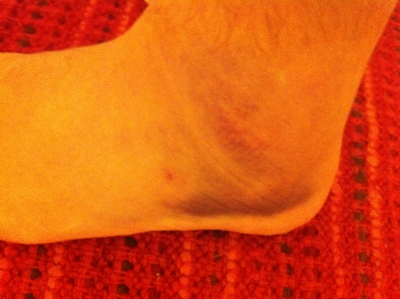 My bruised foot.